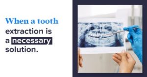 Tooth Extraction