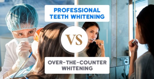 The Advantages of Professional Teeth Whitening vs. DIY, Over-the-Counter Whitening