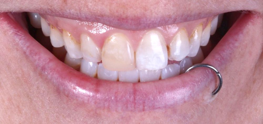 before treatment
