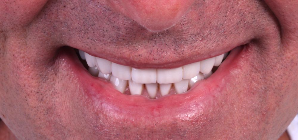 afterbefore treatment