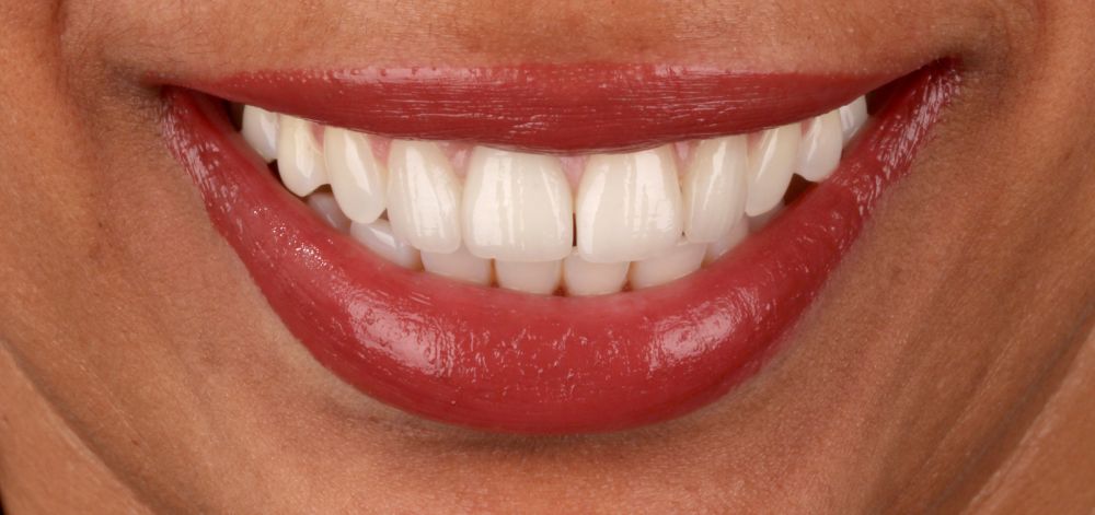 afterbefore treatment