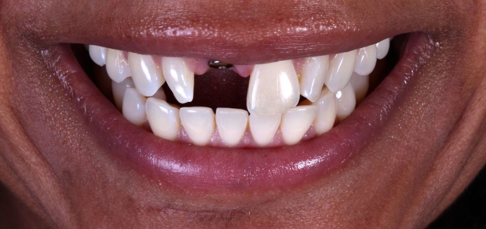 before treatment