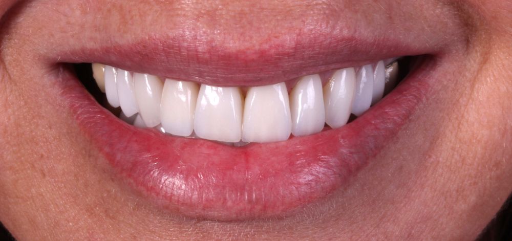 afterbefore treatment