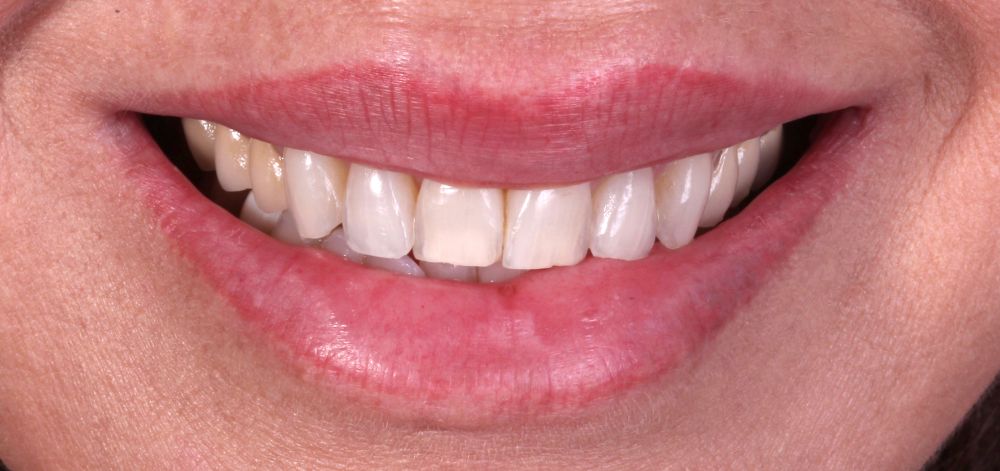 before treatment