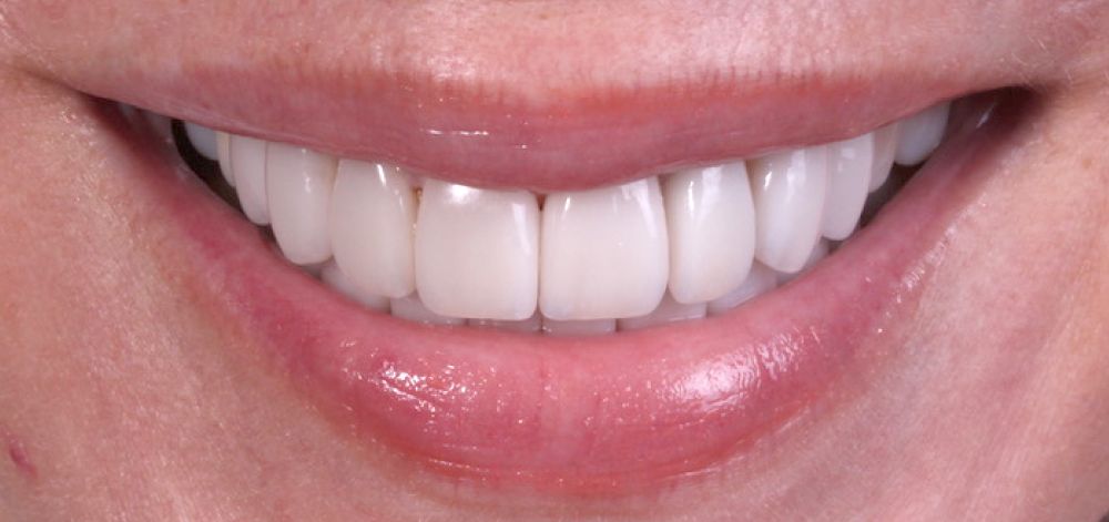 afterbefore treatment