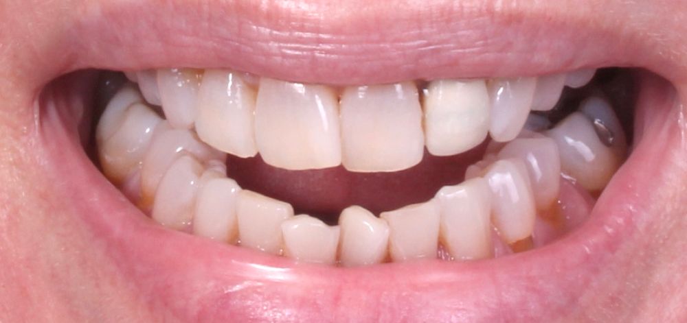 before treatment