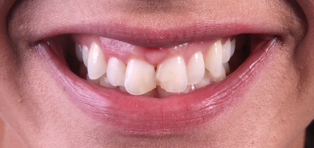 before treatment