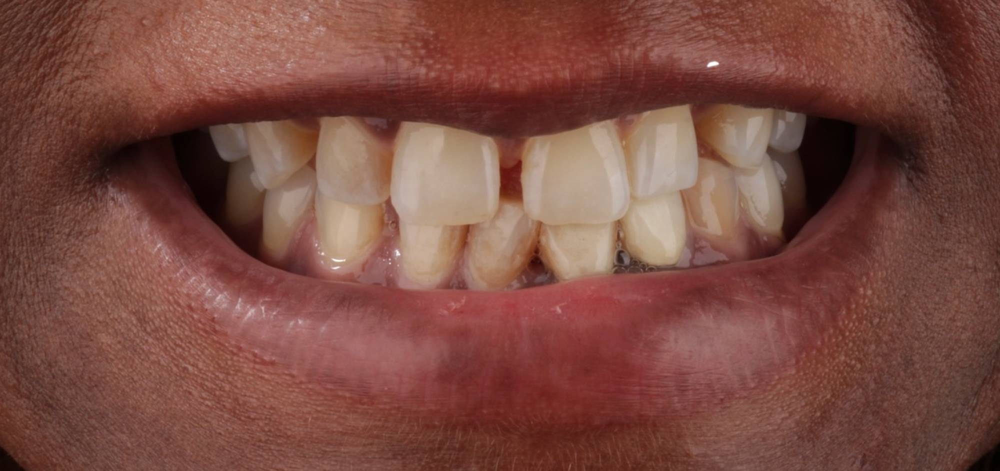 before treatment