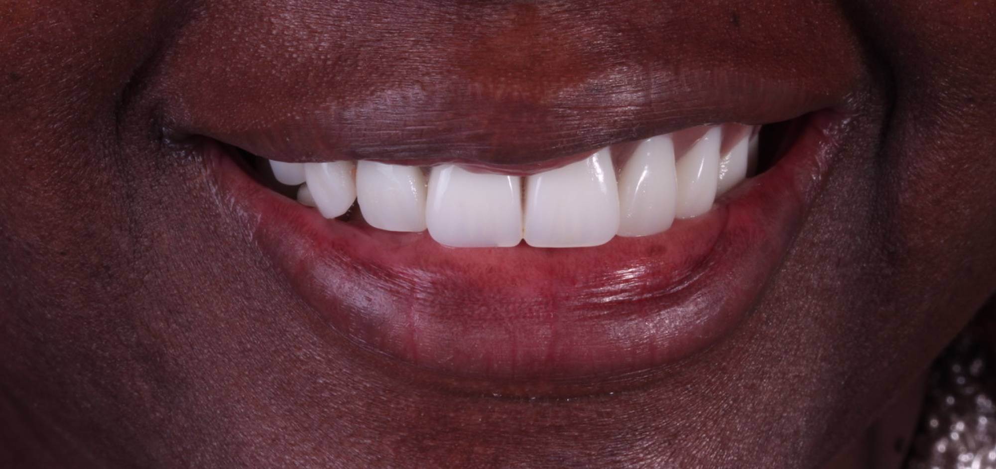 afterbefore treatment