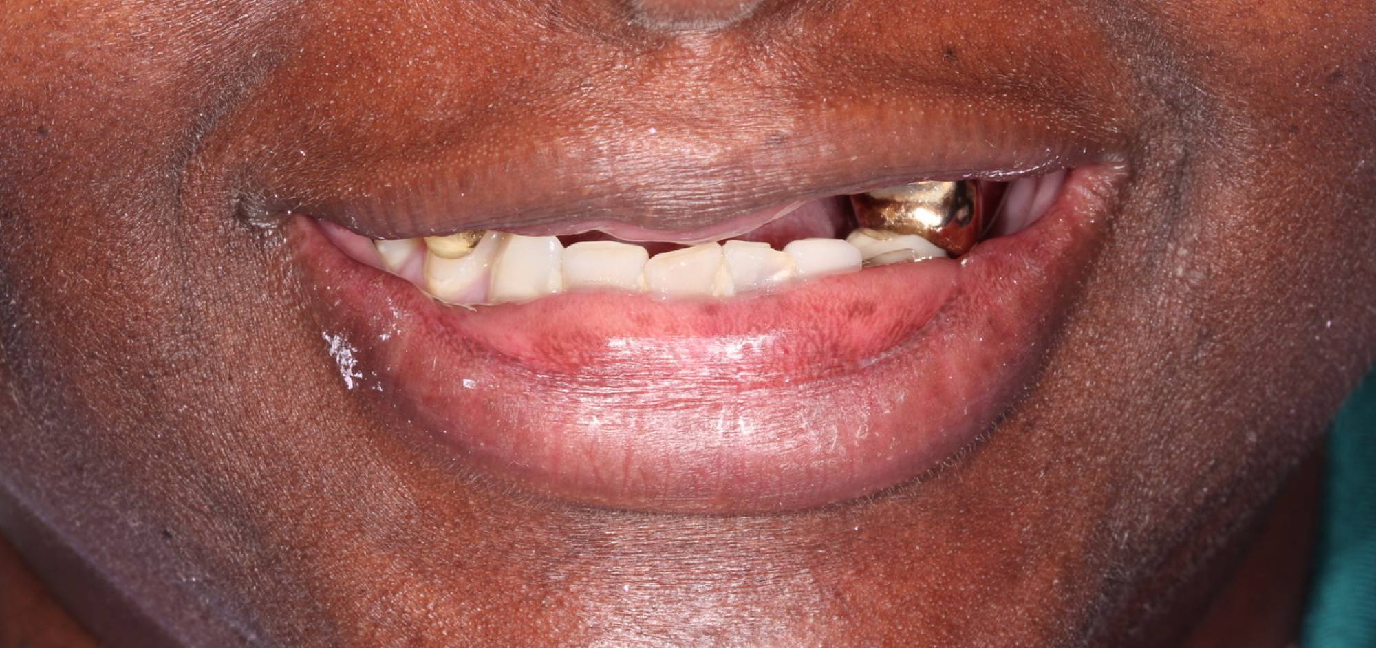 before treatment