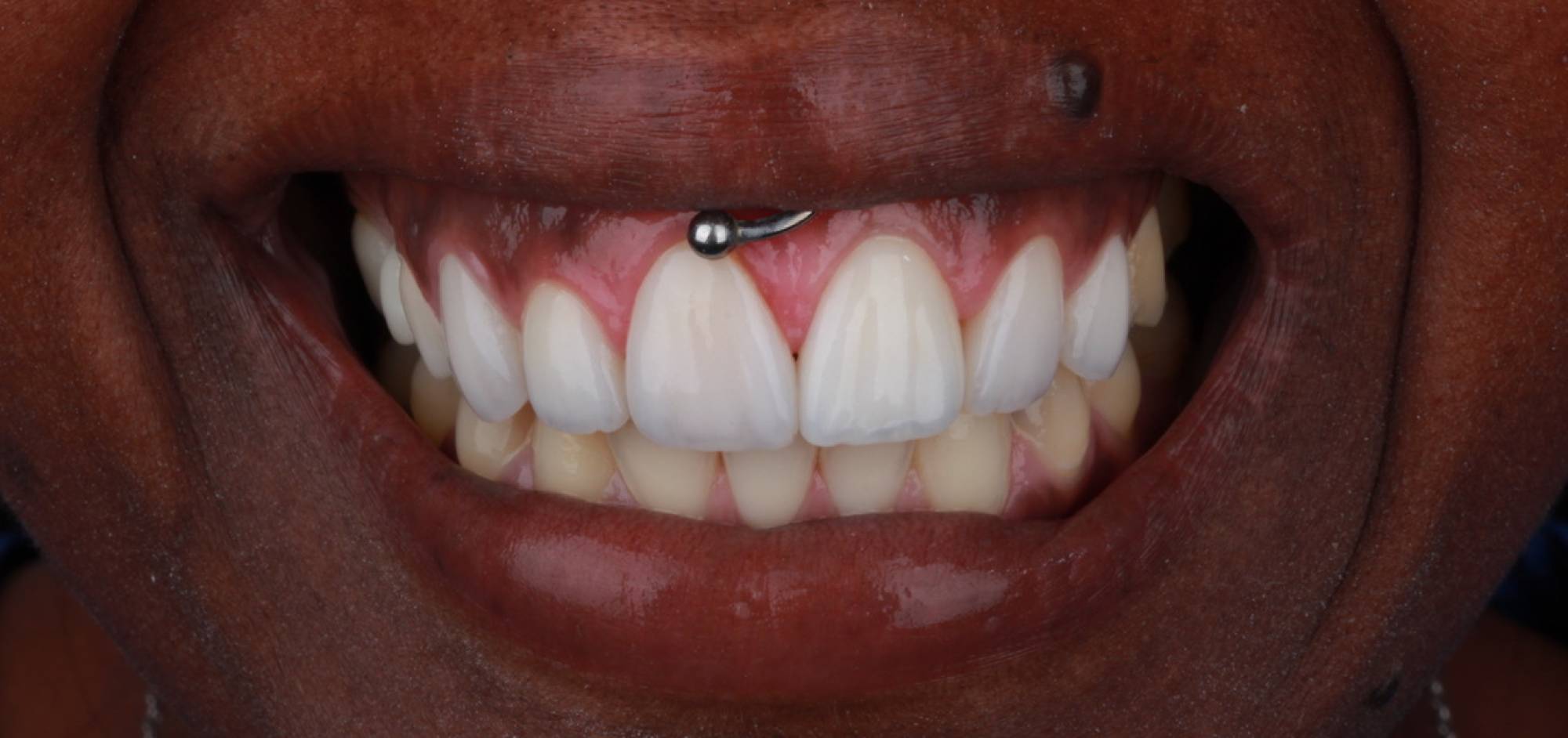 afterbefore treatment
