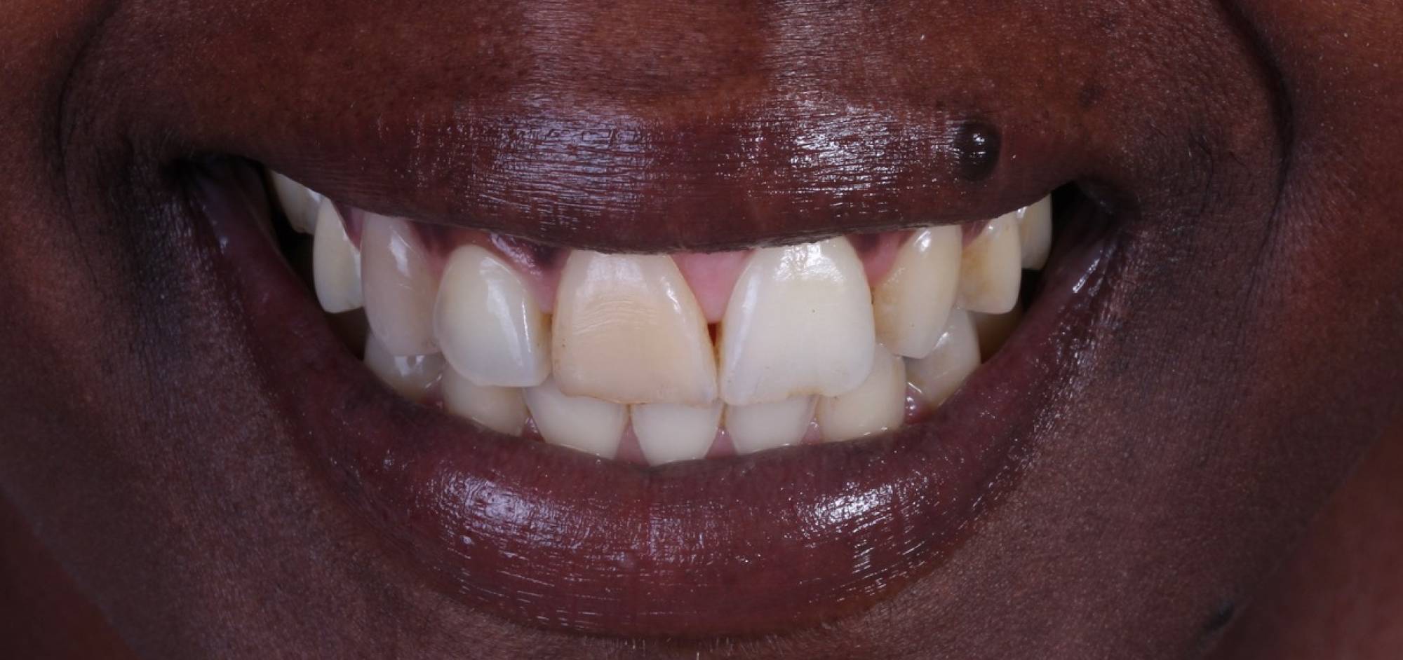 before treatment